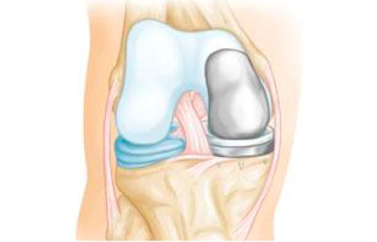 Partial Knee Replacement